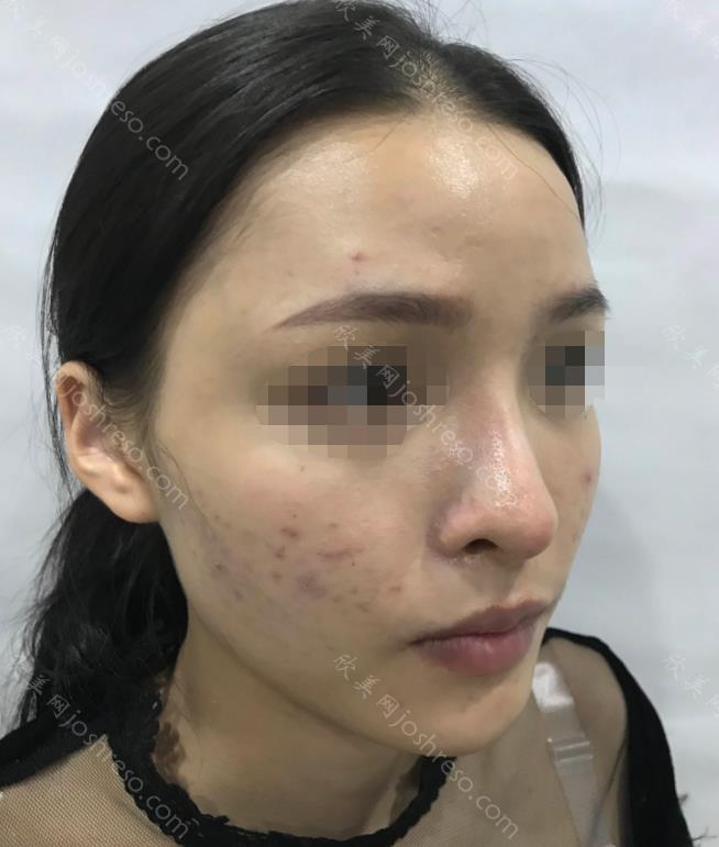 上海九院的孙宝珊做脸部填充怎么样？附真人手术过程实拍图