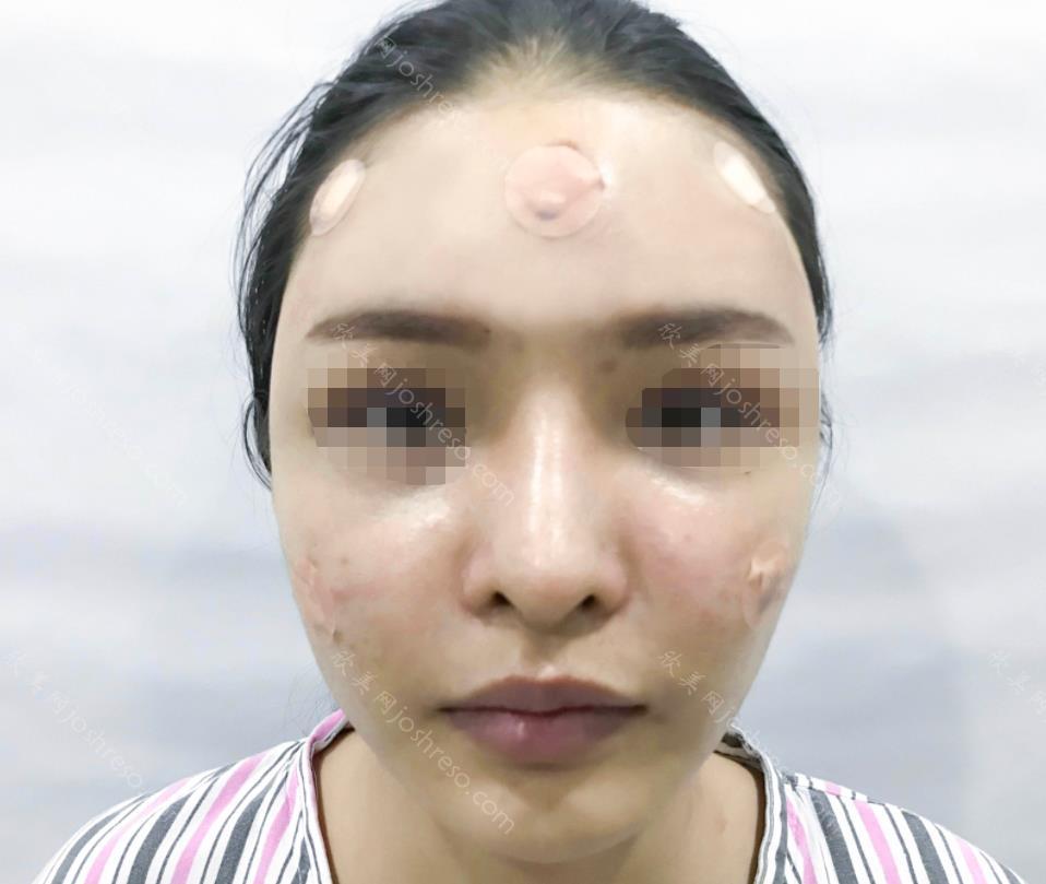 上海九院的孙宝珊做脸部填充怎么样？附真人手术过程实拍图