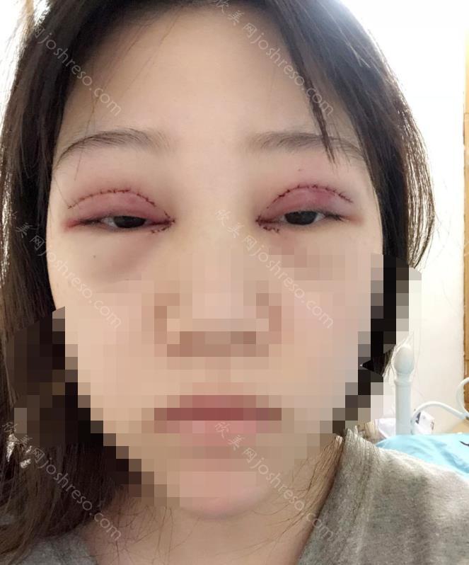 杜园园医生做双眼皮之前