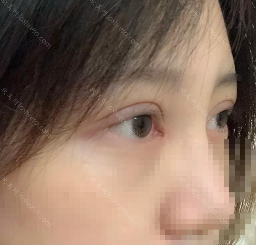 杜园园医生做双眼皮之后