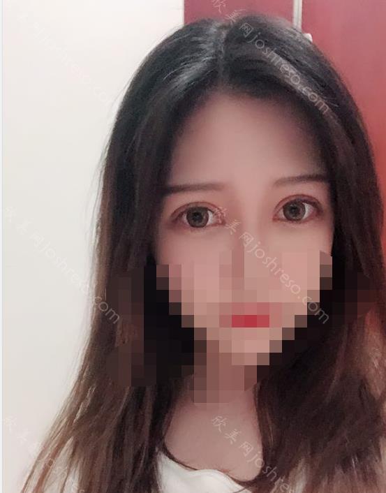 杜园园医生做双眼皮之后