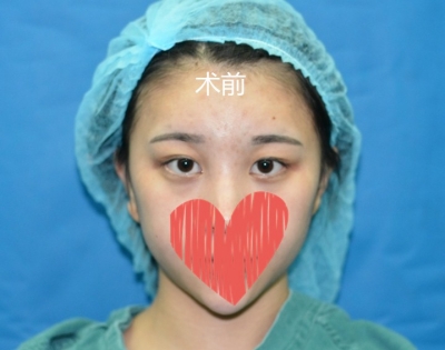 杭州艺星欧阳帆做双眼皮怎么样?隆鼻术前术后图