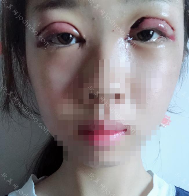 刘志刚医生做双眼皮之前