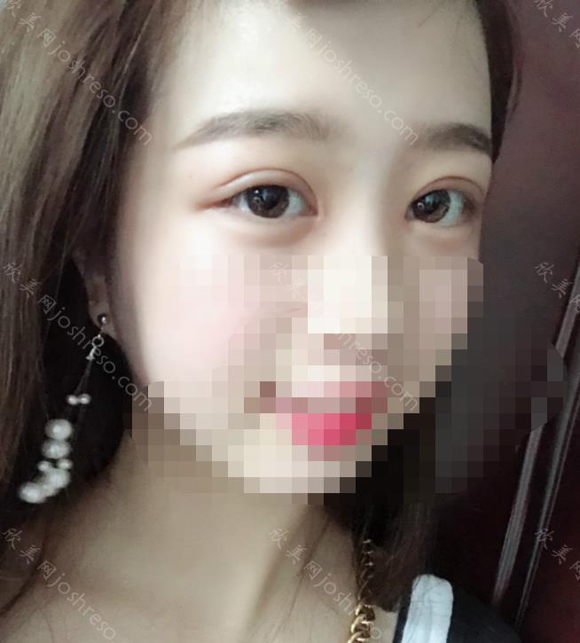 刘志刚医生做双眼皮之后