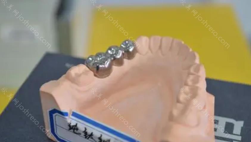 纯钛活动义齿