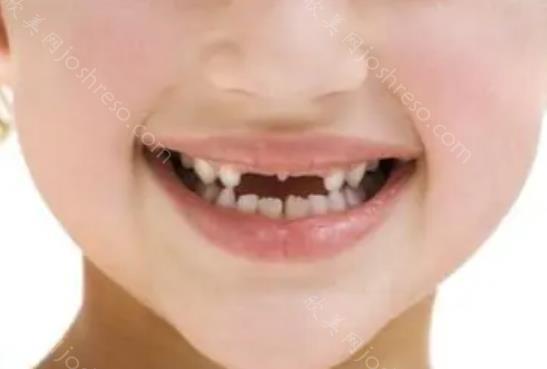 儿童换牙