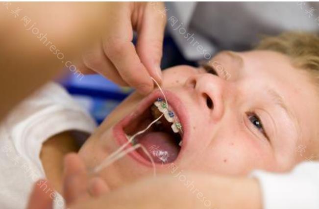 儿童牙齿矫正