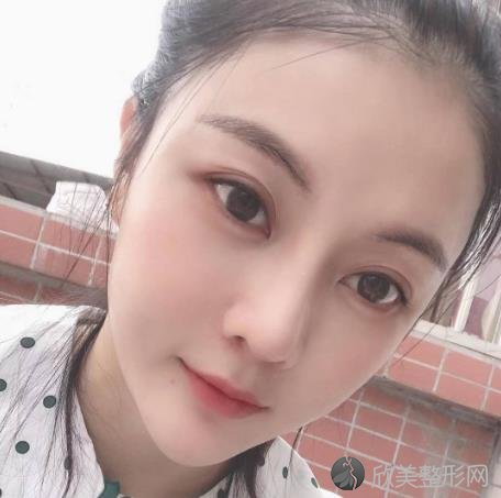 南京美贝尔医院黄明斗隆鼻技术怎么样？看了我的经历就知道效果了