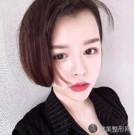 成都美雅娜廖连平鼻修复怎么样?术后一月恢复效果图+价格表