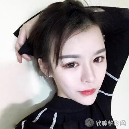 成都美雅娜廖连平鼻修复怎么样?术后一月恢复效果图+价格表