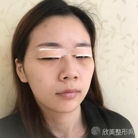 上海仁济医院整形外科正规吗?附双眼皮案例+较新价格表