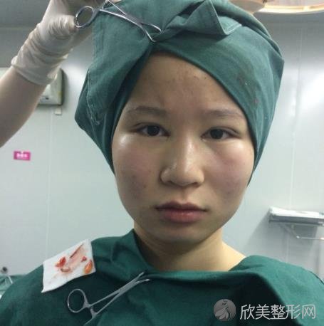 台州市立医院整形美容科怎么样？双眼皮手术恢复过程曝光_价格表查询
