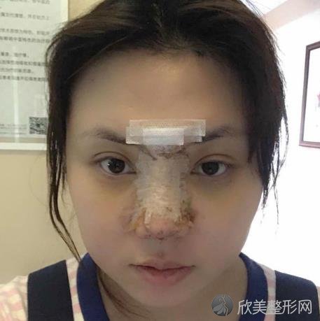 郑州大学第三附属医院整形科隆鼻怎么样？附隆鼻手术恢复过程图+价格表