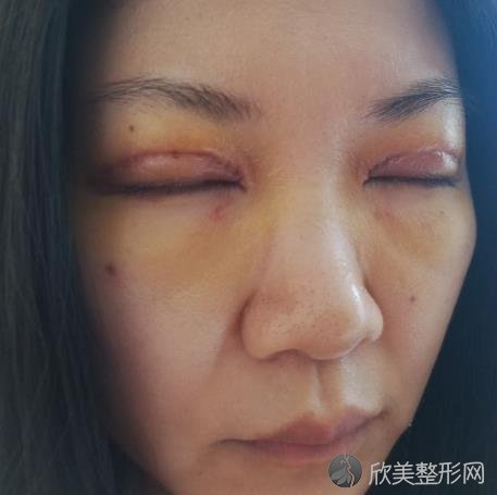 徐州市第三人民医院整形科正规嘛？抓紧看看案例介绍以信息大全就知道啦