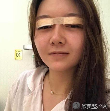 石家庄市妇产医院整形科怎么样？双眼皮手术真实恢复案例过程分享_价格表参