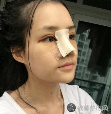 北京煤炭总医院隆鼻怎么样?隆鼻手术恢复效果图一览+全新价格表