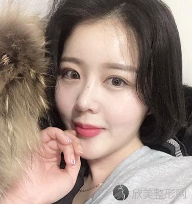 北京伊芙丽格切开双眼皮术后两个月效果图分享，附医生推荐及价格表