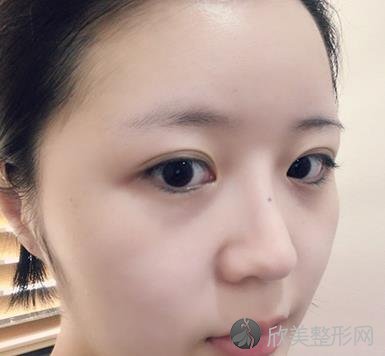北京伊芙丽格切开双眼皮术后两个月效果图分享，附医生推荐及价格表