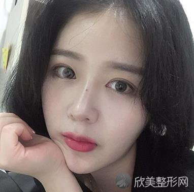 北京伊芙丽格切开双眼皮术后两个月效果图分享，附医生推荐及价格表