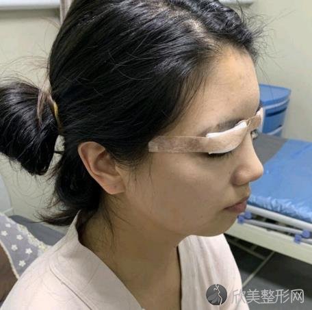 北京曹仁昌双眼皮修复太有气质了！口碑医生！