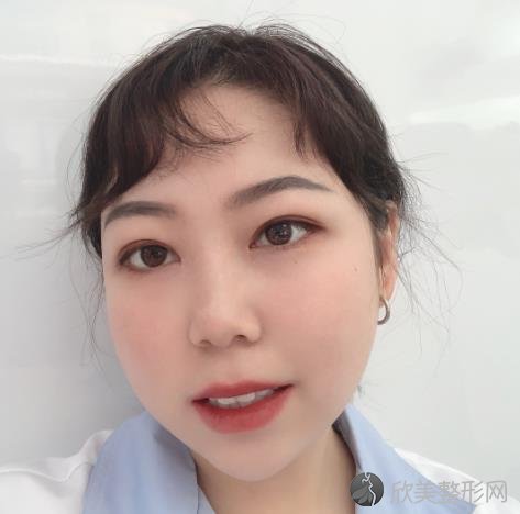深圳北大医院李天石双眼皮修复太好看了吧！小姐姐双眼皮修复真实案例！
