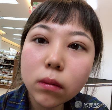 深圳北大医院李天石双眼皮修复太好看了吧！小姐姐双眼皮修复真实案例！