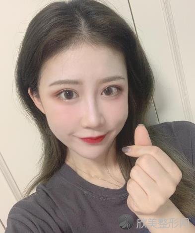石家庄九朵整形医院做双眼皮一个月了，看前后对比效果图一览看术后评价如何