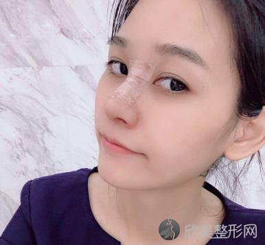 杭州珠儿丽做鼻子术后恢复图来啦，让小姐姐收获了稳稳的幸福！