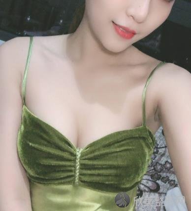 上海东方丽人假体隆胸案例-平胸妹子2个月的恢复蜕变案例来啦！