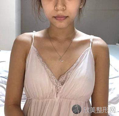 上海东方丽人假体隆胸案例_平胸妹子2个月的恢复蜕变案例来啦！
