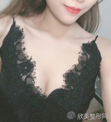 上海东方丽人假体隆胸案例-平胸妹子2个月的恢复蜕变案例来啦！