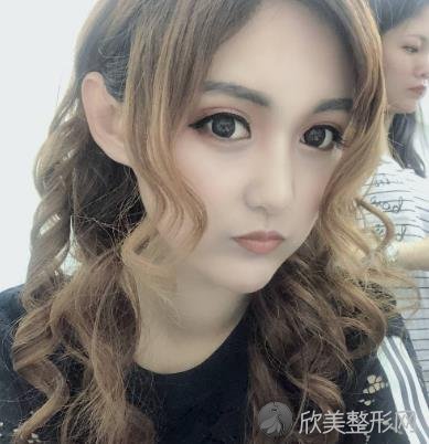 武汉美基元整形医院怎么样?双眼皮手术30天恢复效果图前后对比-价格表查询