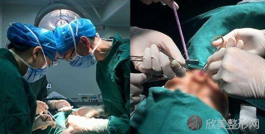 鼻部整形项目包含哪些 隆鼻前期准备及一个月效果分享 价格表查询 欣美整形