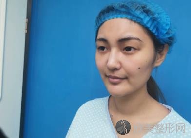 武汉美基元整形医院怎么样?双眼皮手术30天恢复效果图前后对比-价格表查询