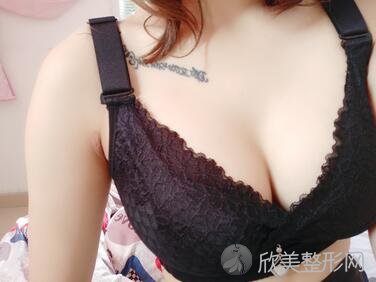 郑大一附院整形科好不好？假体隆胸案例术后效果对比图分享