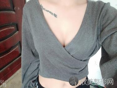 郑大一附院整形科好不好？假体隆胸案例术后效果对比图分享