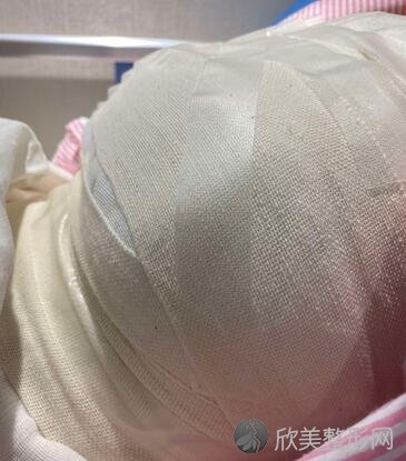 郑大一附院整形科好不好？假体隆胸案例术后效果对比图分享
