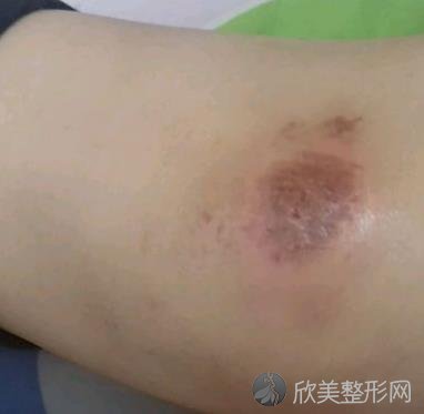 长沙宁乡县人民医院美容科怎么样?去疤痕术后恢复效果图一览