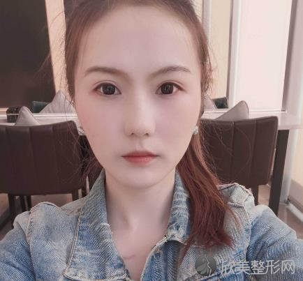 火箭军总医院整形外科做激光点痣怎么样？附手术案例+全新价格表