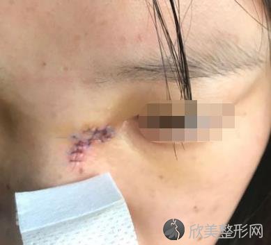 火箭军总医院整形外科做激光点痣怎么样？附手术案例+全新价格表