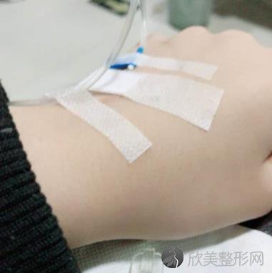 济宁名美整形美容医院好吗？自体脂肪丰胸术后1个月效果+价格表