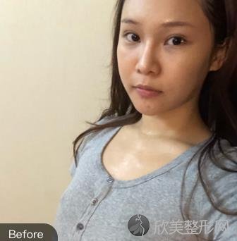济宁名美整形美容医院好吗？自体脂肪丰胸术后1个月效果+价格表