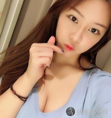 济宁名美整形美容医院好吗？自体脂肪丰胸术后1个月效果+价格表