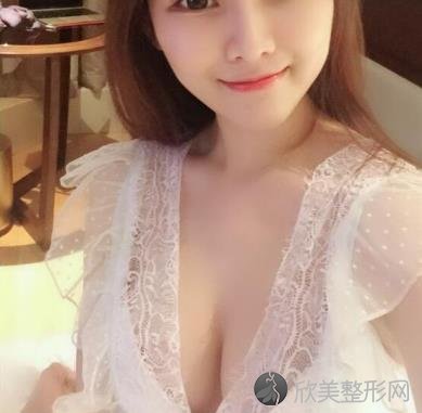 济宁名美整形美容医院好吗？自体脂肪丰胸术后1个月效果+价格表