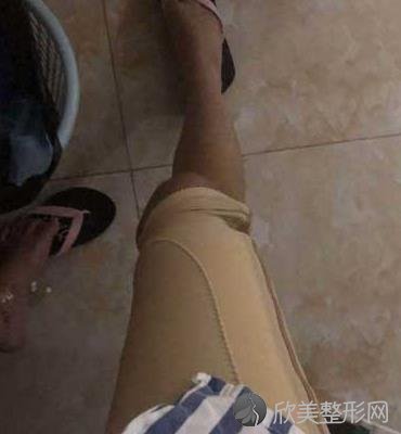 成都军大整形医院正规吗?蒲小兵医生自体脂肪丰胸案例展示，看真实效果很自