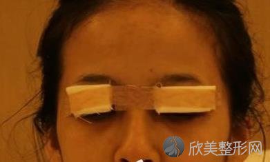 浙江省人民医院整形外科技术怎么样？做外切祛眼袋3个月术前术后分享，含医