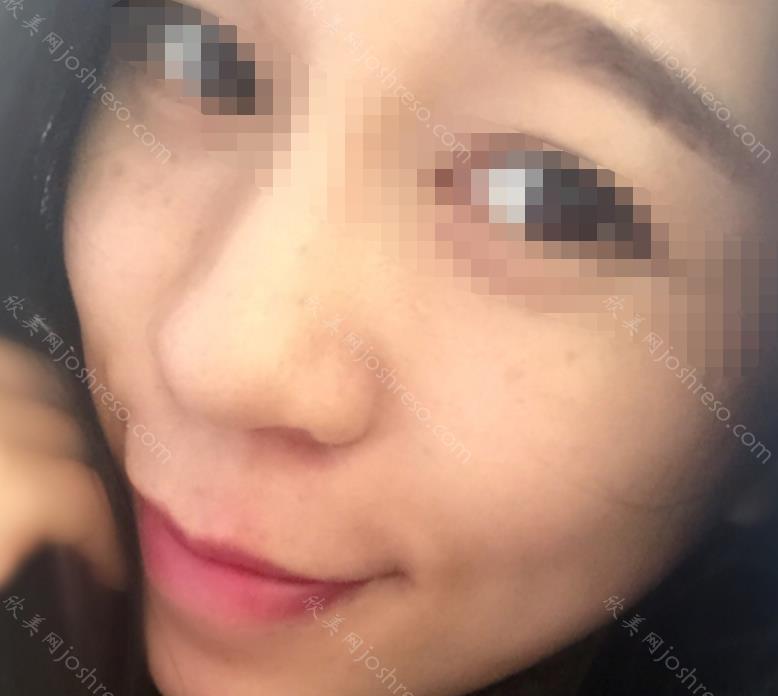 法令纹去除之后