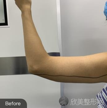 沈阳军区总医院整形美容科手臂抽脂怎么样？附案例分享及较新价格表！