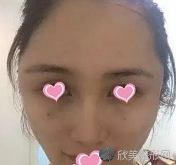 南充达芬奇整形医院怎么样?玻尿酸填充面部案例分享-价格表参考