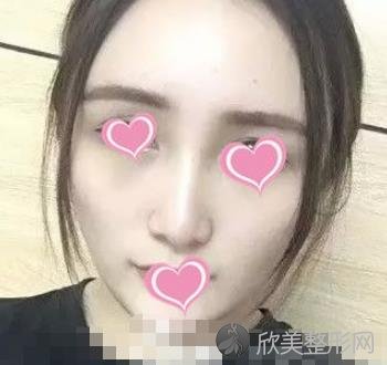 南充达芬奇整形医院怎么样?玻尿酸填充面部案例分享-价格表参考